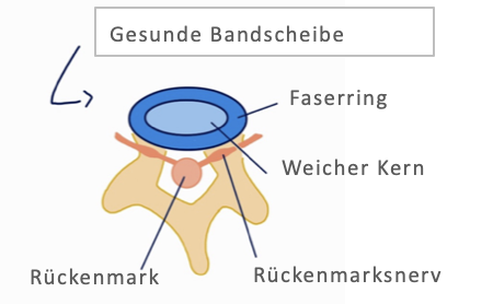 Anatomische Darstellung eines Bandscheibenvorfalls an der Wirbelsäule